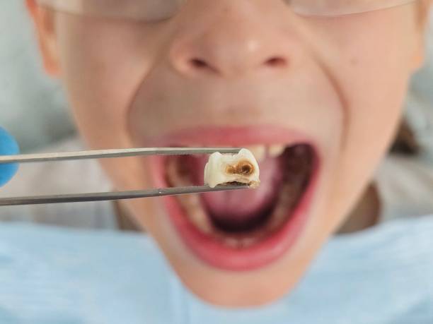 Best Emergency Root Canal Treatment in Sachse, TX